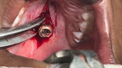 مركز النهضه لطب الاسنان بعطبرة ينجح في اجراء عمليه معقده لطفله اصابها طلق ناري استقر في حلقها 4 المسار نيوز مركز النهضه لطب الاسنان بعطبرة ينجح في اجراء عمليه معقده لطفله اصابها طلق ناري استقر في حلقها